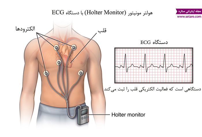علت تپش قلب - درمان تپش قلب - دستگاه هولتر مونیتور - نوار قلب متحرک