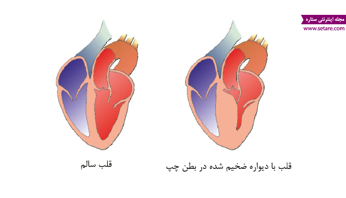 چرا عضله قلب ضخیم میشود