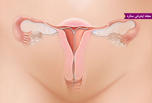 گذاشتن آی یو دی - IUD برای پیشگیری از حاملگی - کویل ضد حاملگی