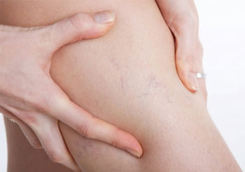 رگ عنکبوتی در بارداری چیست و چگونه درمان میشود؟