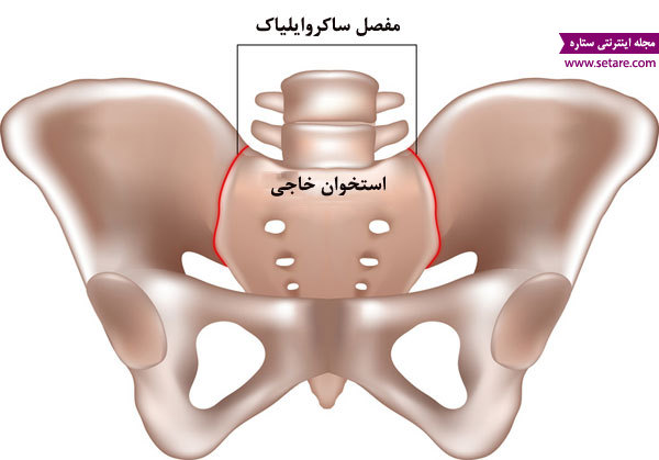 کمر درد در بارداری - عکس مفصل ساکروایلیاک - درمان کمر درد