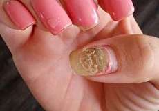 قارچ ناخن کاشت شده را جدی بگیرید