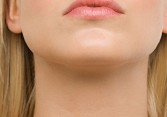 جراحی پروتز چانه چگونه انجام میگیرد؟