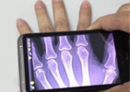 تکنولوژی جدید موبایل برای گرفتن عکس رادیولوژی