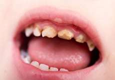 علل فساد و پوسیدگی دندان شیری کودکان چیست؟
