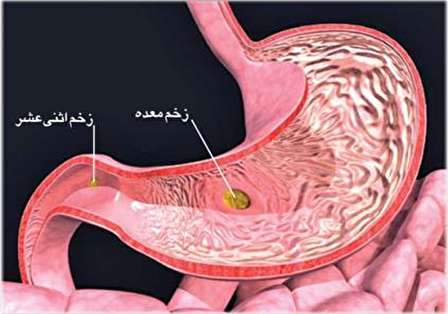زخم اثنی عشر چیست و چگونه درمان میشود؟