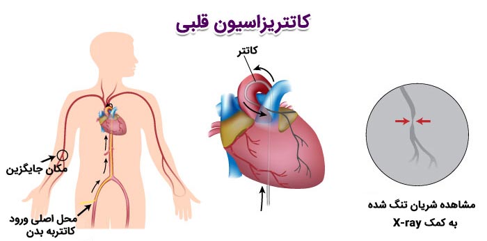 درمان و تشخیص حمله قلبی