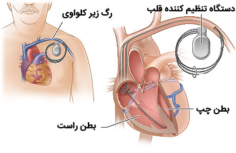 درمان حمله قلبی با دستگاه تنظیم کننده قلب