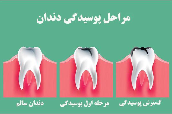 مراحل پوسیدگی دندان 