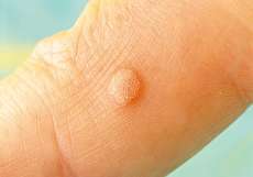 بیماری HPV چیست؟ + علت، علائم و راه های درمان