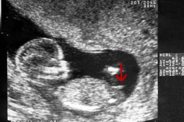 آیا تعیین جنسیت جنین در هفته 12 بارداری ممکن است؟
