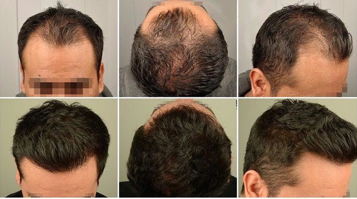 درباره پروتز مو چه میدانید؟ درباره پروتز مو چه میدانید؟