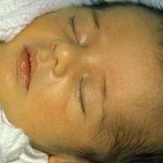 راه های درمان زردی نوزادان