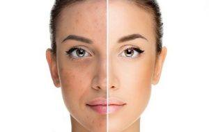 جوان سازی پوست