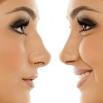 جراحی زیبایی بینی