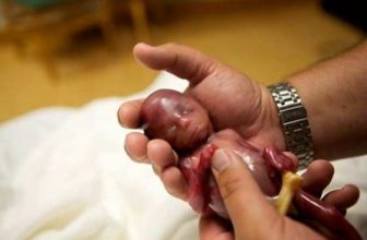 سقط جنین در دوران بارداری