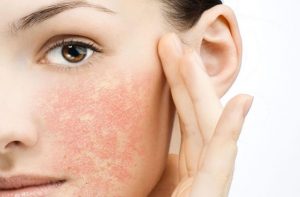 درمان پوست خشک صورت