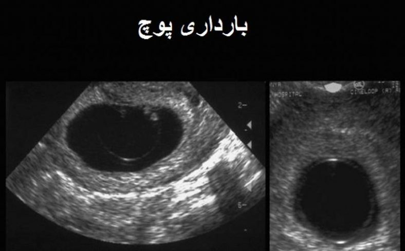 حاملگی پوچ
