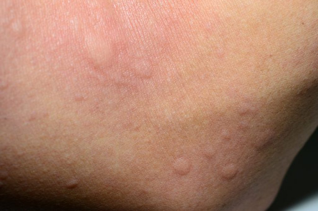 حساسیت پوستی چیست و چگونه درمان می شود؟ - ستاره