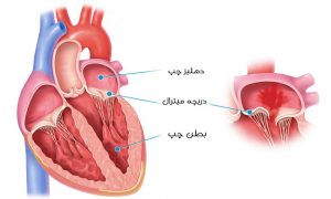 افتادگی دریچه میترال