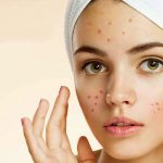 ماسک برای جوش صورت