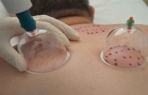 فواید حجامت