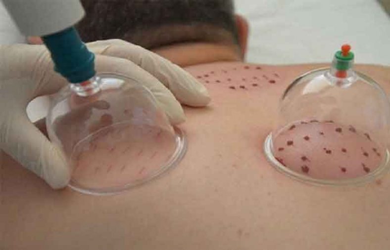 فواید حجامت