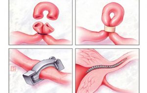 بستن لوله های رحم