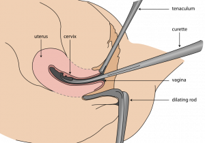 فیلم کورتاژ جنین