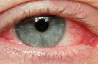 علت قرمزی چشم