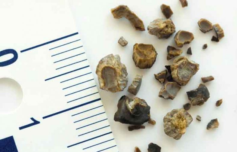 سنگ کلیه