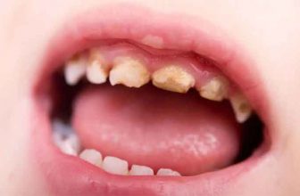 پوسیدگی دندان شیری کودکان