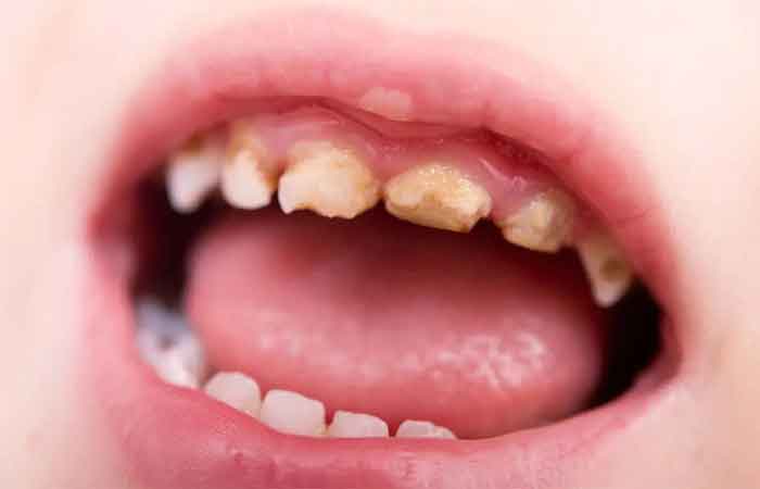 پوسیدگی دندان شیری کودکان