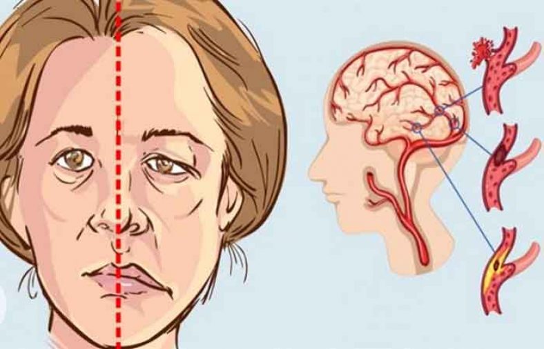 عوارض سکته مغزی