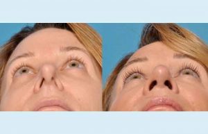 انحراف بینی