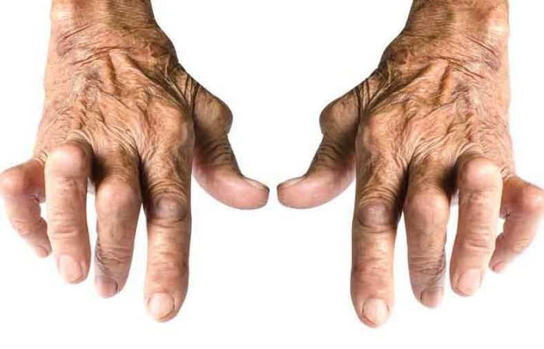 آرتروز انگشتان دست