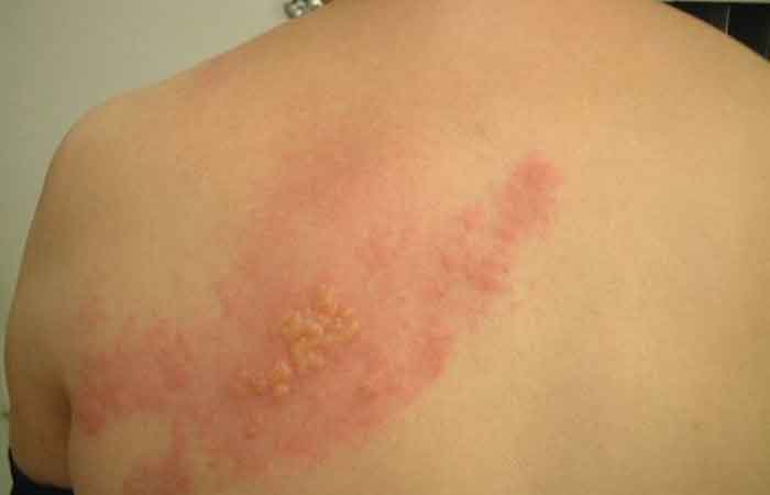 عکس بیماری زونا در زنان