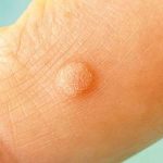 بیماری HPV