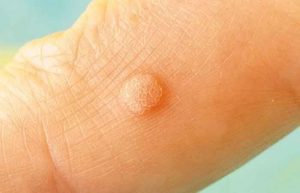 بیماری HPV