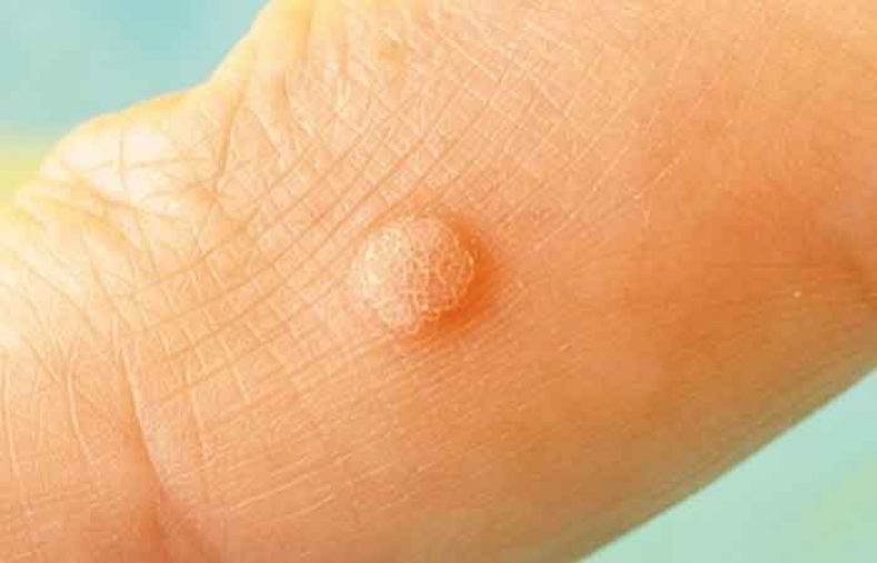بیماری HPV