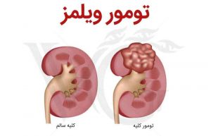 تومور ویلمز