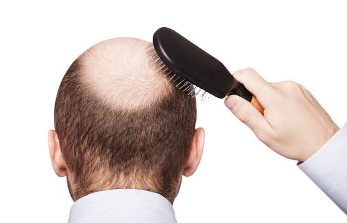 بهترین درمان ریزش مو چیست؟ - ستاره