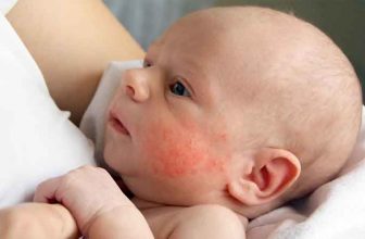حساسیت به شیر در نوزادان