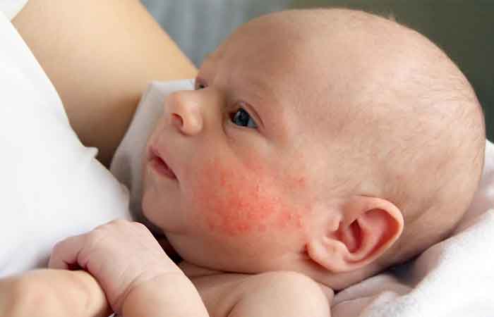 حساسیت به شیر در نوزادان