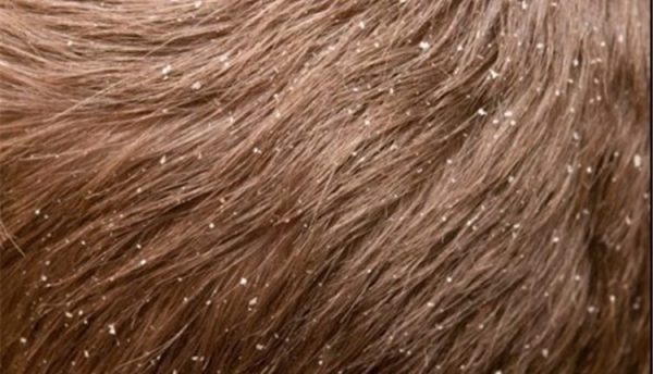 درمان شوره با شستشوی مو با جوش شیرین