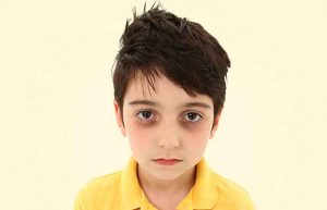 سیاهی زیر چشم کودک