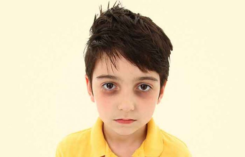 سیاهی زیر چشم کودک