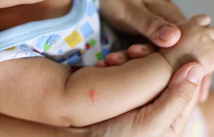 راه های درمان نیش حشرات در کودکان