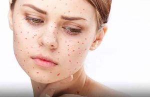 ابتلا به سرخجه در بارداری