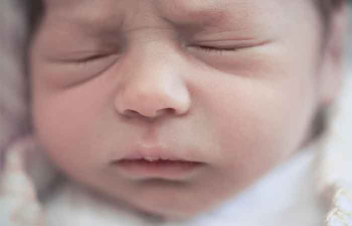 انحراف بینی در نوزادان